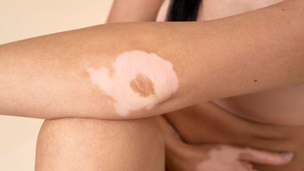 Vitiligo: Understanding Causes, Symptoms, and Effective Treatments